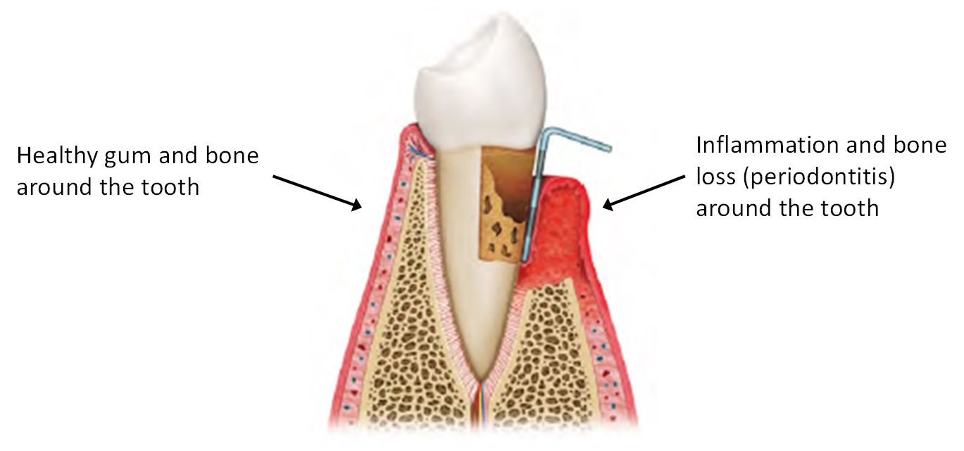 Differences in supporting tissues in health and periodontitis