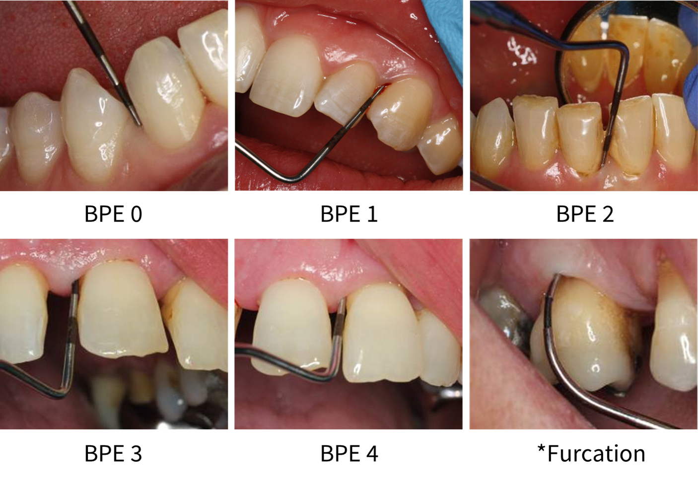The depth of a periodontal probe for sites with BPE codes 0, 1, 2, 3, 4 and *