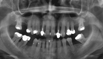 Panoramic radiograph