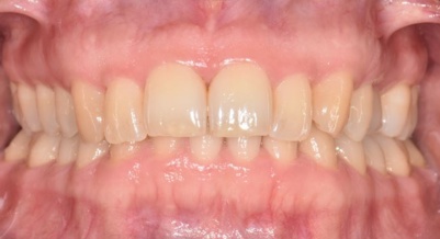 A patient with gingival and periodontal health
