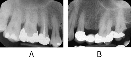 Peri-apical radiographs