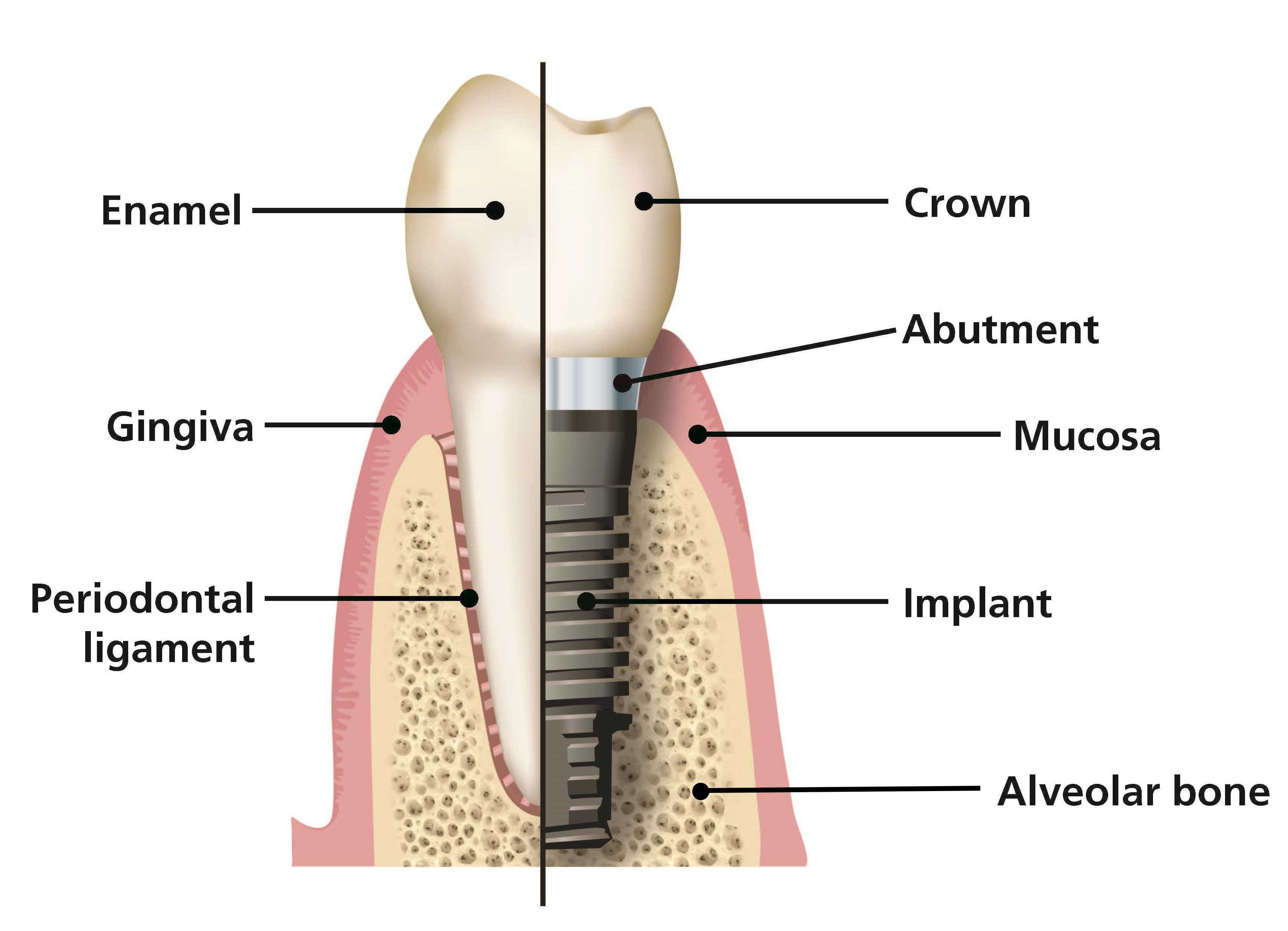 The anatomical differences between a tooth and a dental implant