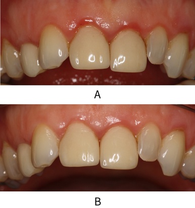 A patient with gingivitis before and after treatment