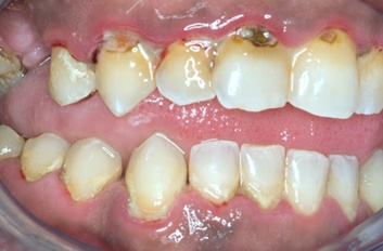 A patient with necrotising ulcerative gingivitis